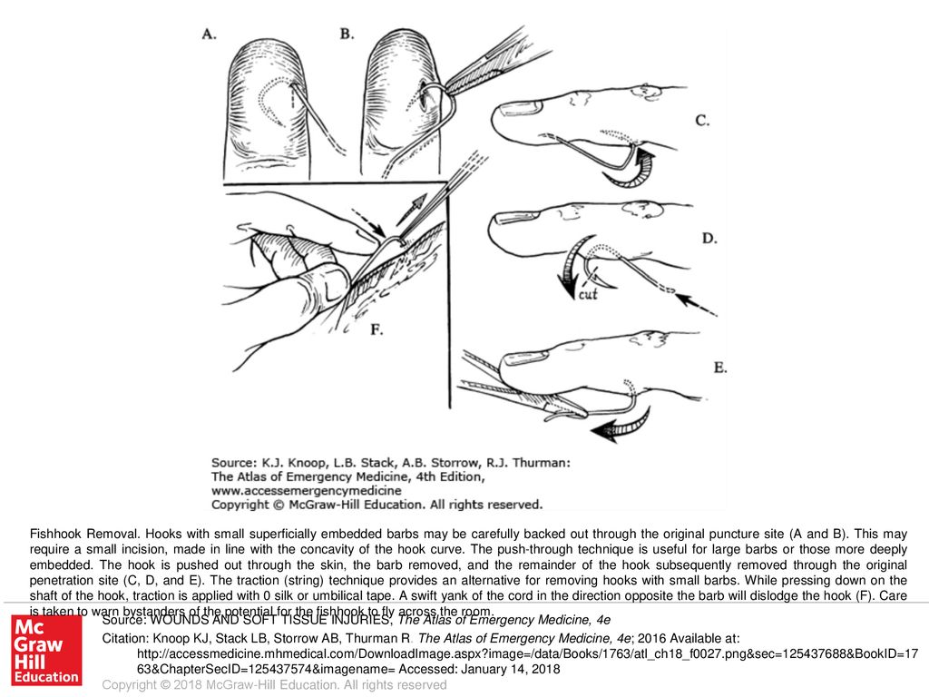 Fishhook Removal. Hooks with small superficially embedded barbs