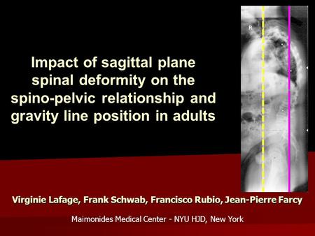 Impact of sagittal plane spinal deformity on the spino-pelvic relationship and gravity line position in adults Virginie Lafage, Frank Schwab, Francisco.
