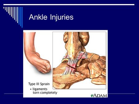 Ankle Injuries.