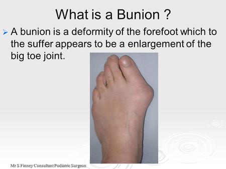 Mr S Finney Consultant Podiatric Surgeon What is a Bunion ?  A bunion is a deformity of the forefoot which to the suffer appears to be a enlargement of.
