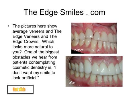 The Edge Smiles. com The pictures here show average veneers and The Edge Veneers and The Edge Crowns. Which looks more natural to you? One of the biggest.