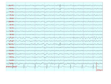 Picture 2. Electrode artifact at O1. The morphology is very unusual for any cerebral waveform, and the distribution is limited to a single electrode.