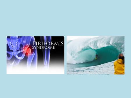 Piriformis Syndrome Situation where the piriformis muscle is compressing the sciatic nerve resulting in sciatic neuropathy.