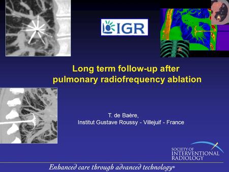 Long term follow-up after pulmonary radiofrequency ablation T. de Baère, Institut Gustave Roussy - Villejuif - France.