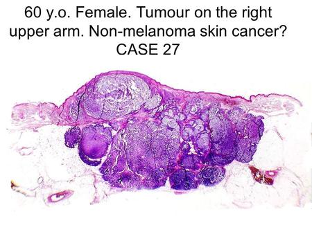 60 y. o. Female. Tumour on the right upper arm