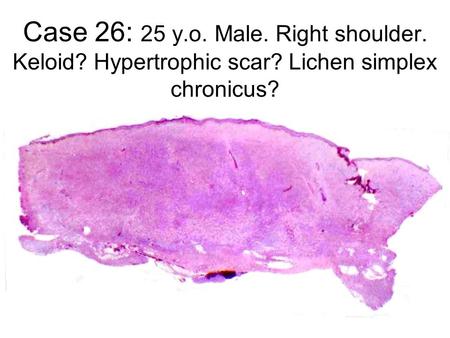 Case 26: 25 y.o. Male. Right shoulder. Keloid? Hypertrophic scar? Lichen simplex chronicus?