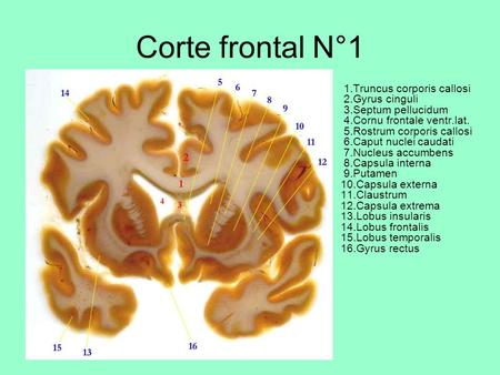 Corte frontal N°1  1.Truncus corporis callosi  2.Gyrus cinguli  3.Septum pellucidum  4.Cornu frontale ventr.lat.  5.Rostrum corporis callosi  6.Caput nuclei.