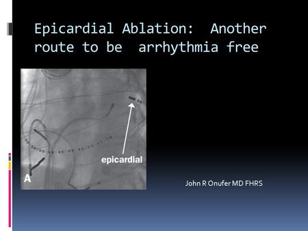 Epicardial Ablation: Another route to be arrhythmia free John R Onufer MD FHRS.