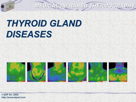 © EDP Srl, 2004  THYROID GLAND DISEASES.