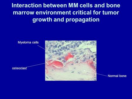 Interaction between MM cells and bone marrow environment critical for tumor growth and propagation osteoclast Myeloma cells Normal bone.