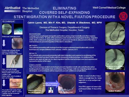 ELIMINATING COVERED SELF-EXPANDING STENT MIGRATION WITH A NOVEL FIXATION PROCEDURE STENT MIGRATION WITH A NOVEL FIXATION PROCEDURE Calvin Lyons, MD, Min.