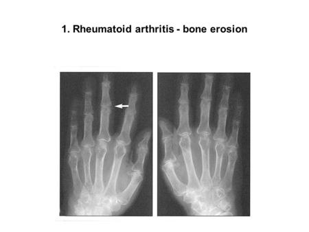 1. Rheumatoid arthritis - bone erosion