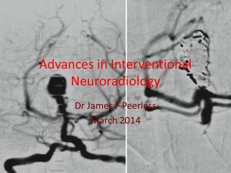 Advances in Interventional Neuroradiology Dr James F Peerless March 2014.