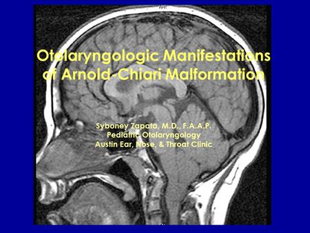 Otolaryngologic Manifestations of Arnold-Chiari Malformation Syboney Zapata, M.D., F.A.A.P. Pediatric Otolaryngology Austin Ear, Nose, & Throat Clinic.
