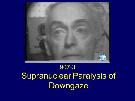 Supranuclear Paralysis of Downgaze 907-3. Eye Movements Global paralysis of downgaze Absent convergence Slow saccades on upgaze Deviation of the eyes.