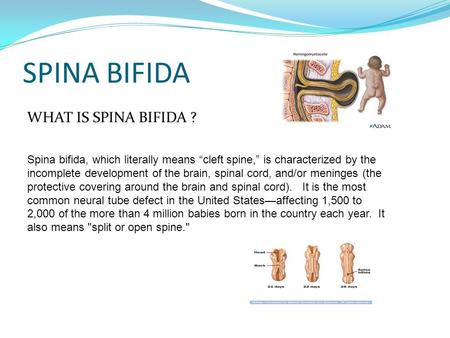 SPINA BIFIDA Spina bifida, which literally means “cleft spine,” is characterized by the incomplete development of the brain, spinal cord, and/or meninges.