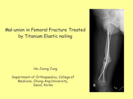 Mal-union in Femoral Fracture Treated by Titanium Elastic nailing Department of Orthopaedics, College of Medicine, Chung-Ang University, Seoul, Korea Ho-Joong.