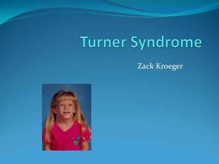 Zack Kroeger. Alternate names TS Monosomy X Ullrich- Turner Syndrome 45,X.