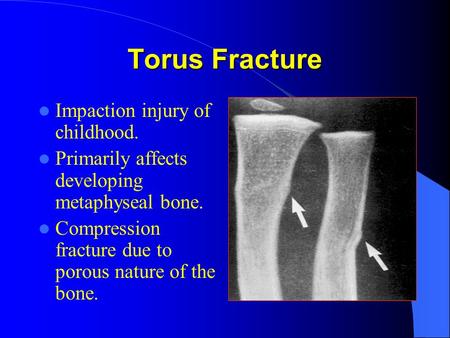 Torus Fracture Impaction injury of childhood.