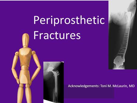 Periprosthetic Fractures