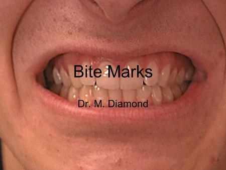 Bite Marks Dr. M. Diamond. Dental Identification Victims –Especially from fires or explosions –By dental records Suspects –Match dental impressions to.