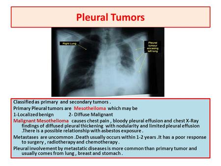 Pleural Tumors Classified as primary and secondary tumors . Primary Pleural tumors are Mesotheiloma which may be 1-Localized benign 2- Diffuse Malignant.