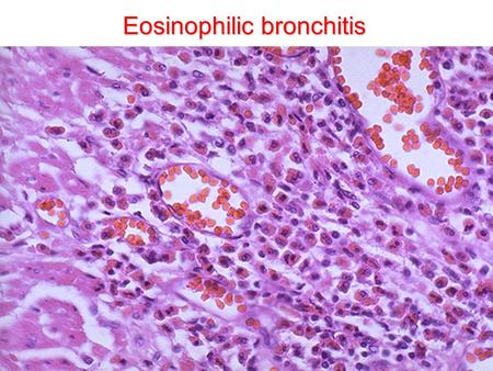 Eosinophilic bronchitis. Exercise, cold air Eosinophilic bronchitis Airway hyperresponsiveness Late asthmatic reaction Early asthmatic reaction Allergen.
