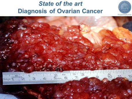 Diagnosis of Ovarian Cancer