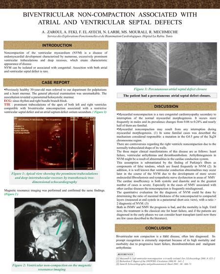 INTRODUCTION BIVENTRICULAR NON-COMPACTION ASSOCIATED WITH ATRIAL AND VENTRICULAR SEPTAL DEFECTS A. ZAROUI, A. FEKI, F. EL AYECH, N. LARBI, MS. MOURALI,