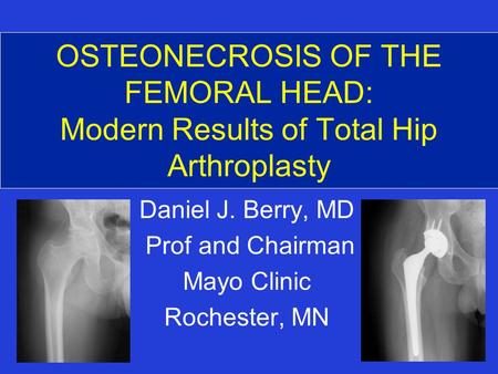 OSTEONECROSIS OF THE FEMORAL HEAD: Modern Results of Total Hip Arthroplasty Daniel J. Berry, MD Prof and Chairman Mayo Clinic Rochester, MN.