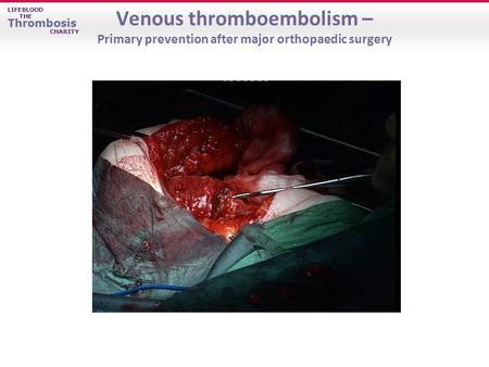 Venous thromboembolism –