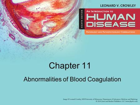 Chapter 11 Abnormalities of Blood Coagulation.