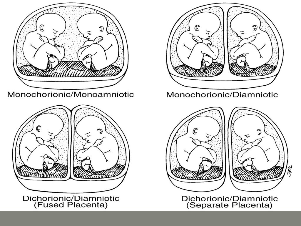 Multiple Fetal Pregnancy - ppt download