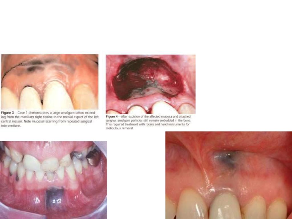 Black Gums | Dark Gums | Gum Treatment in Vadodara- Aries Oro-Facial Dental