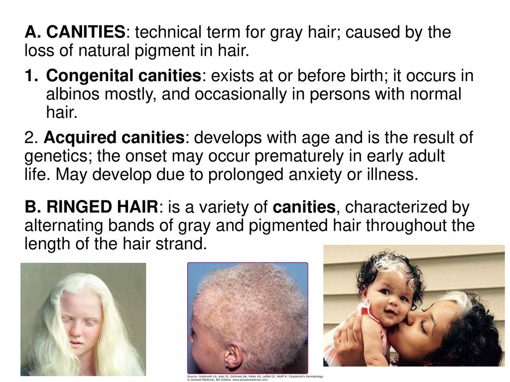A. CANITIES: technical term for gray hair; caused by the loss of natural  pigment in hair. Congenital canities: exists at or before birth; it occurs  in. - ppt download