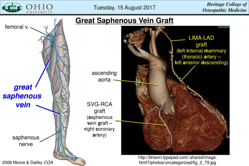 great saphenous vein graft