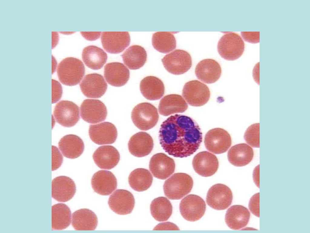 Повышенные базофилы и эозинофилы в крови. Эозинофилы под микроскопом. Эозинофилы (EOS) 10*9/Л. Эозинофилы в микроскоп. Эозинофильное окрашивание.