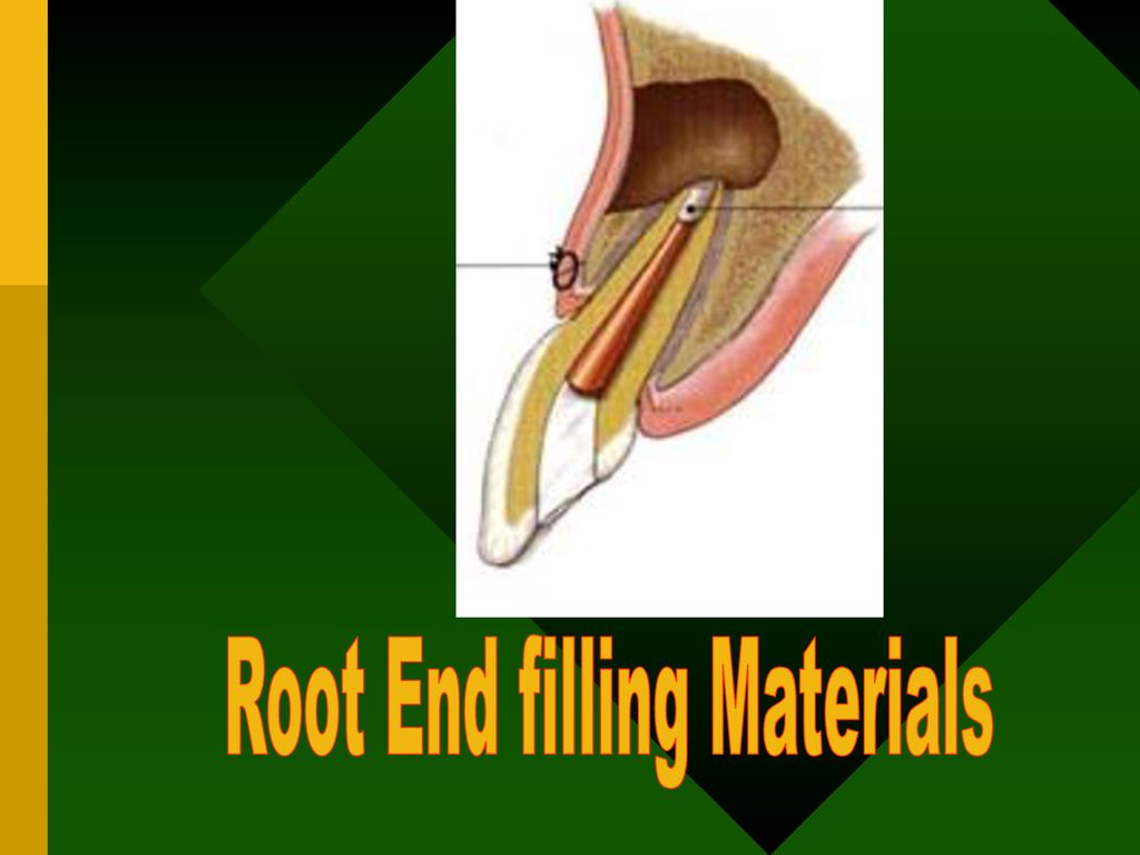 Root End filling Materials - ppt download