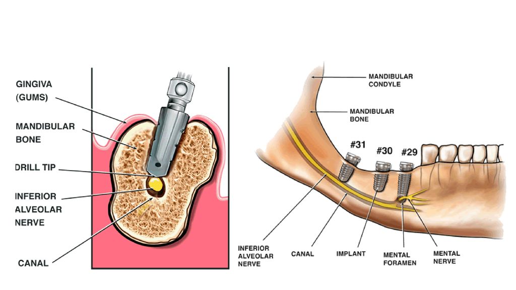 Dental Malpractice Central Inferior Alveolar Nerve Anatomy