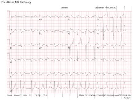 Elias Hanna, MD, Cardiology. Differential diagnosis: Anterior STEMI with hyperacute ischemic T wave and inferior ST depression versus Hyperkalemia. -However,