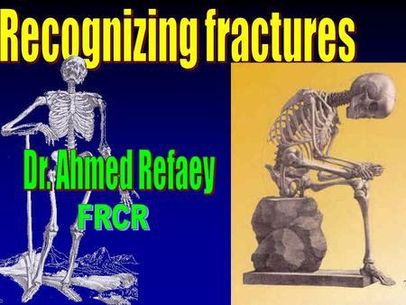 Recognizing fractures