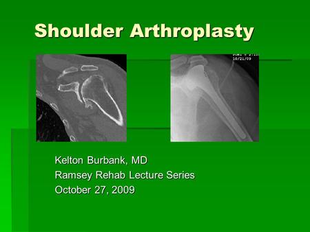 Shoulder Arthroplasty Kelton Burbank, MD Ramsey Rehab Lecture Series October 27, 2009.