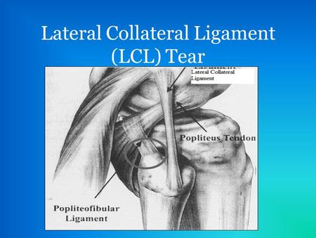 Lateral Collateral Ligament (LCL) Tear. Development of LCL Tear A varus force to the medial aspect of the knee while bearing weight can put enough stress.