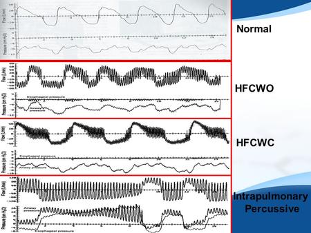 Normal HFCWO HFCWC Intrapulmonary Percussive. Case Report 7/14-8/3/2011  21 year old female admitted with acute respiratory failure requiring mechanical.