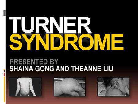 TURNER SYNDROME PRESENTED BY SHAINA GONG AND THEANNE LIU.