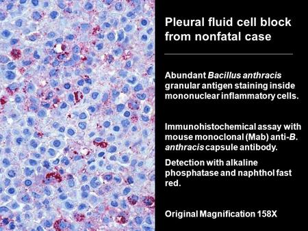 Pleural fluid cell block from nonfatal case Abundant Bacillus anthracis granular antigen staining inside mononuclear inflammatory cells. Immunohistochemical.