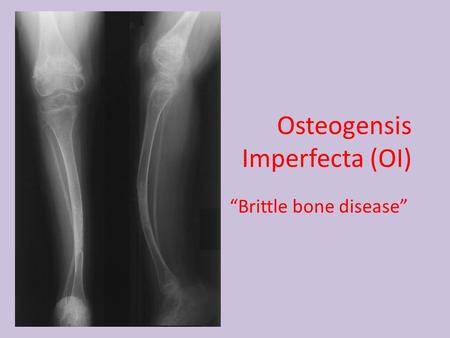 Osteogensis Imperfecta (OI) “Brittle bone disease”