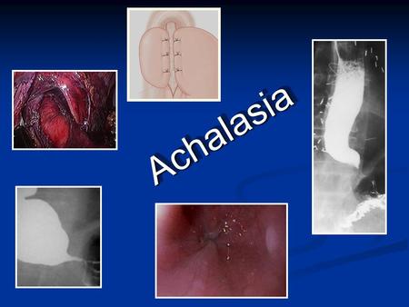 AchalasiaAchalasia. BackgroundBackground Sir Thomas Willis first described achalasia in 1672. In 1881, von Mikulicz described the disease as a cardiospasm.