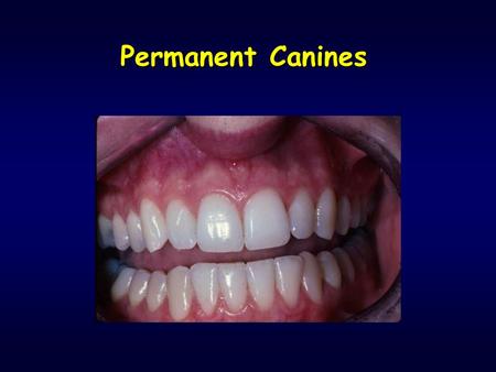 Permanent Canines.