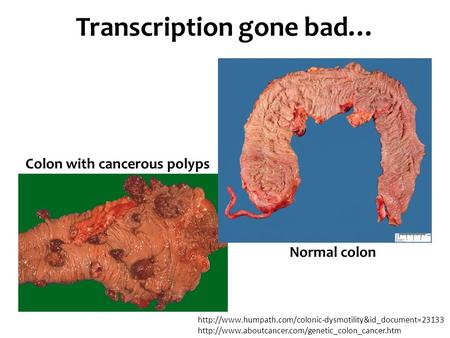 Normal colon Colon with cancerous polyps